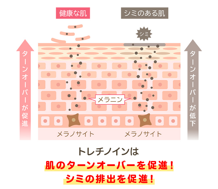 トレチノイン・ハイドロキノン療法